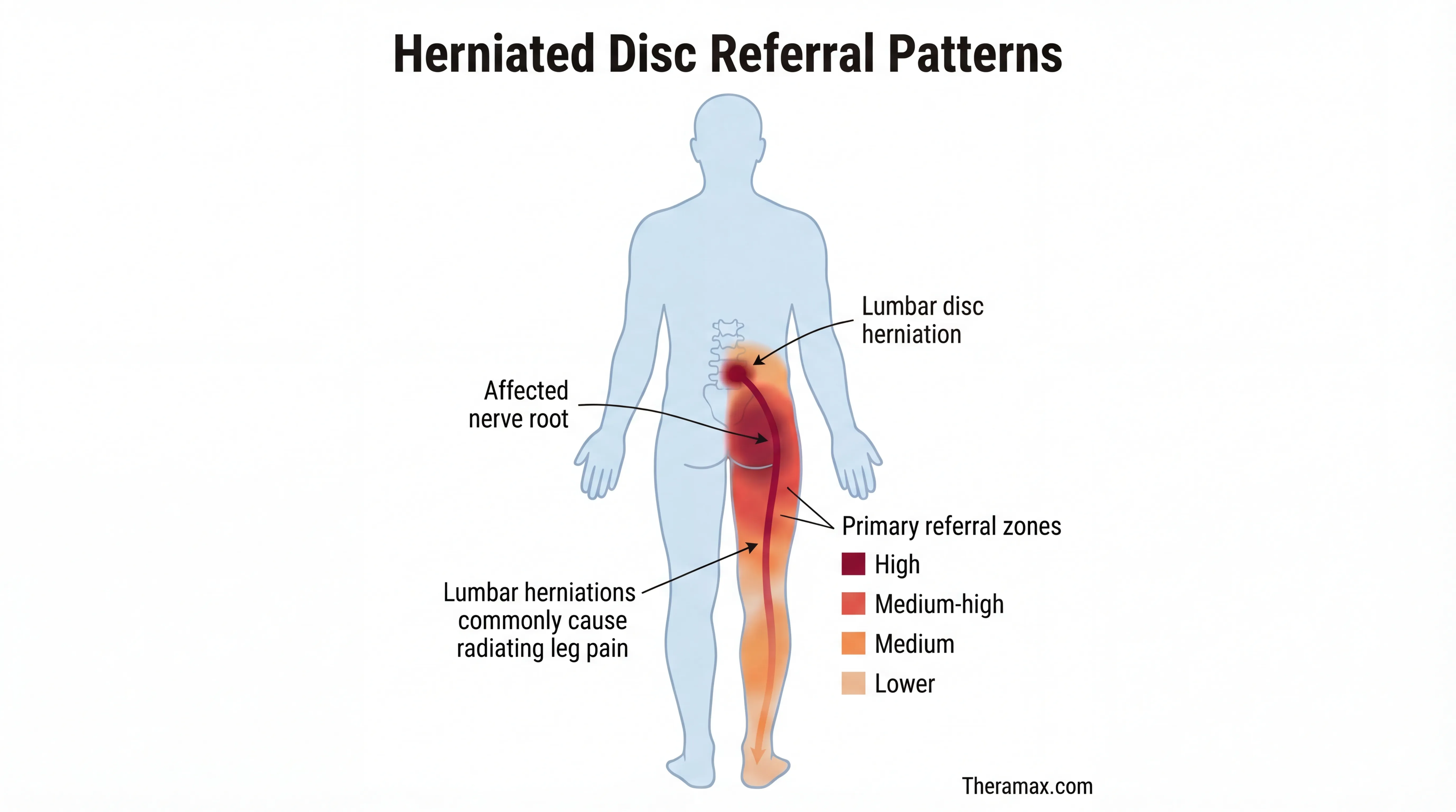 Herniated disc symptom map showing sciatic nerve pain pathway from lumbar spine to leg